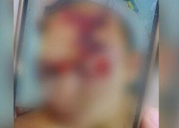 Mulher tem rosto desfigurado com agressões brutais do marido em Bodoquena