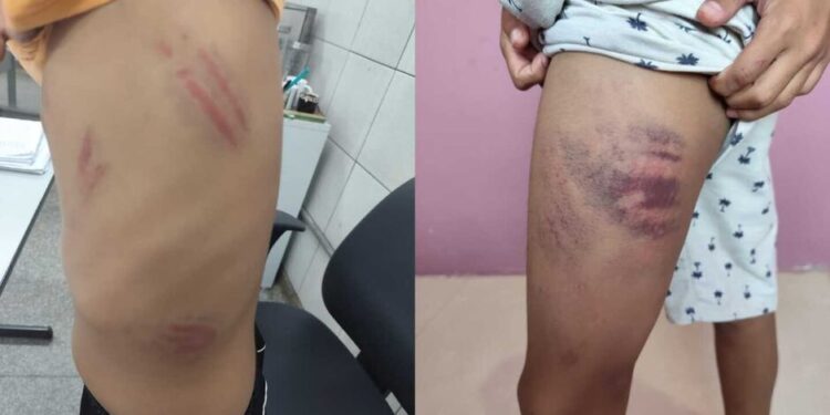 Menino autista é surrado dentro e fora da escola e Conselho Tutelar denuncia omissão em Campo Grande